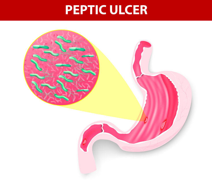 ピロリ菌は胃の粘膜に棲みつく細菌